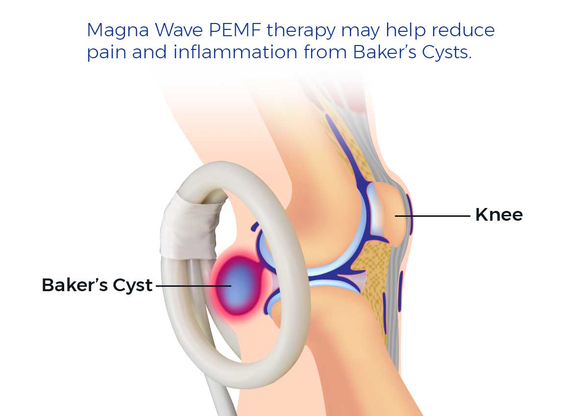 Magna Wave PEMF therapy may help reduce pain and inflammation from Baker's Cysts