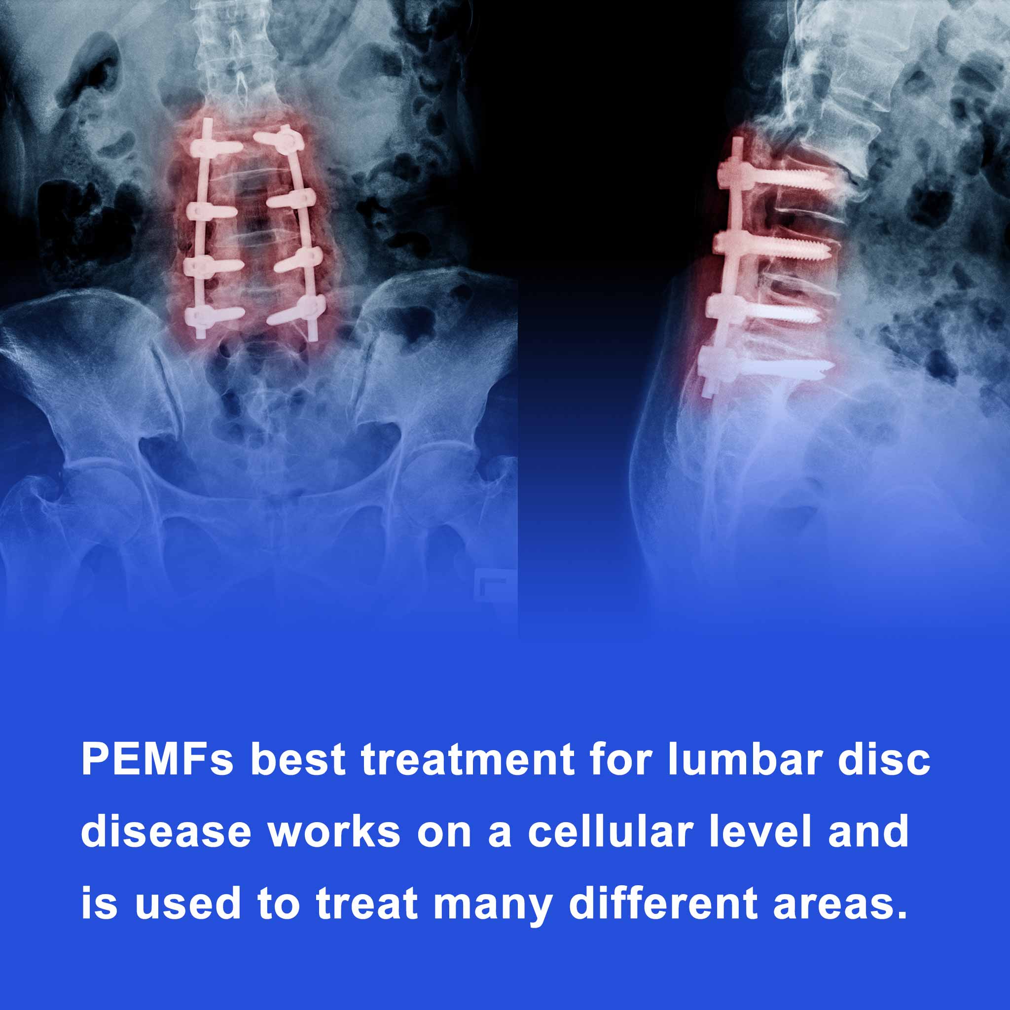 PEMFs best treatment for lumbar disc disease works on a cellular level and is used to treat many different areas.