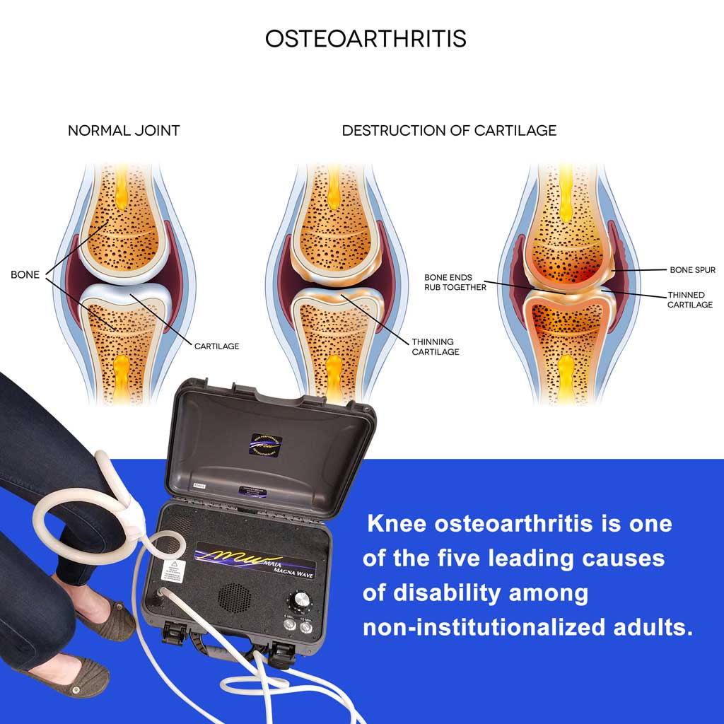 Magna Wave PEMF Best Treatment for Osteoarthritis - Diagram of Normal Knee Joint & Destruction of Cartilage - Knee osteoarthritis is one of the five leading causes of disability among non-institutionalized adults.