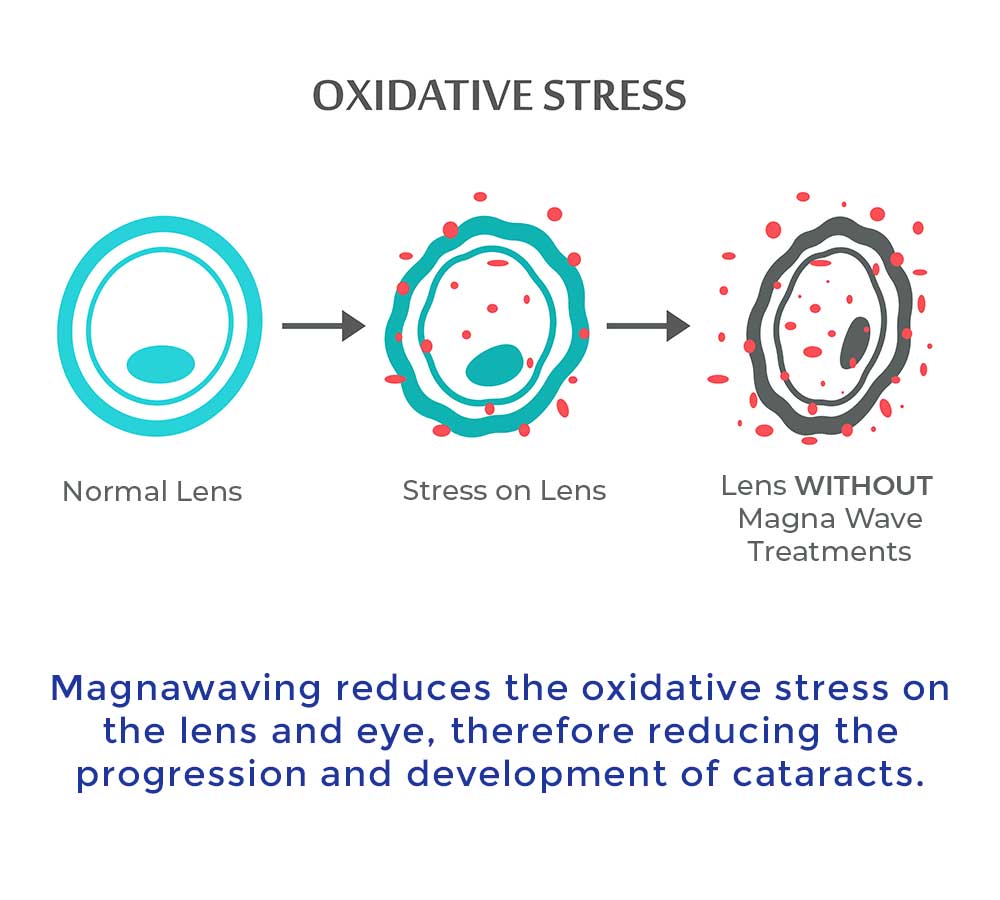 Magnawaving reduces the oxidative stress on the lens and eye, therefore reducing the progression and developmentof cataracts.