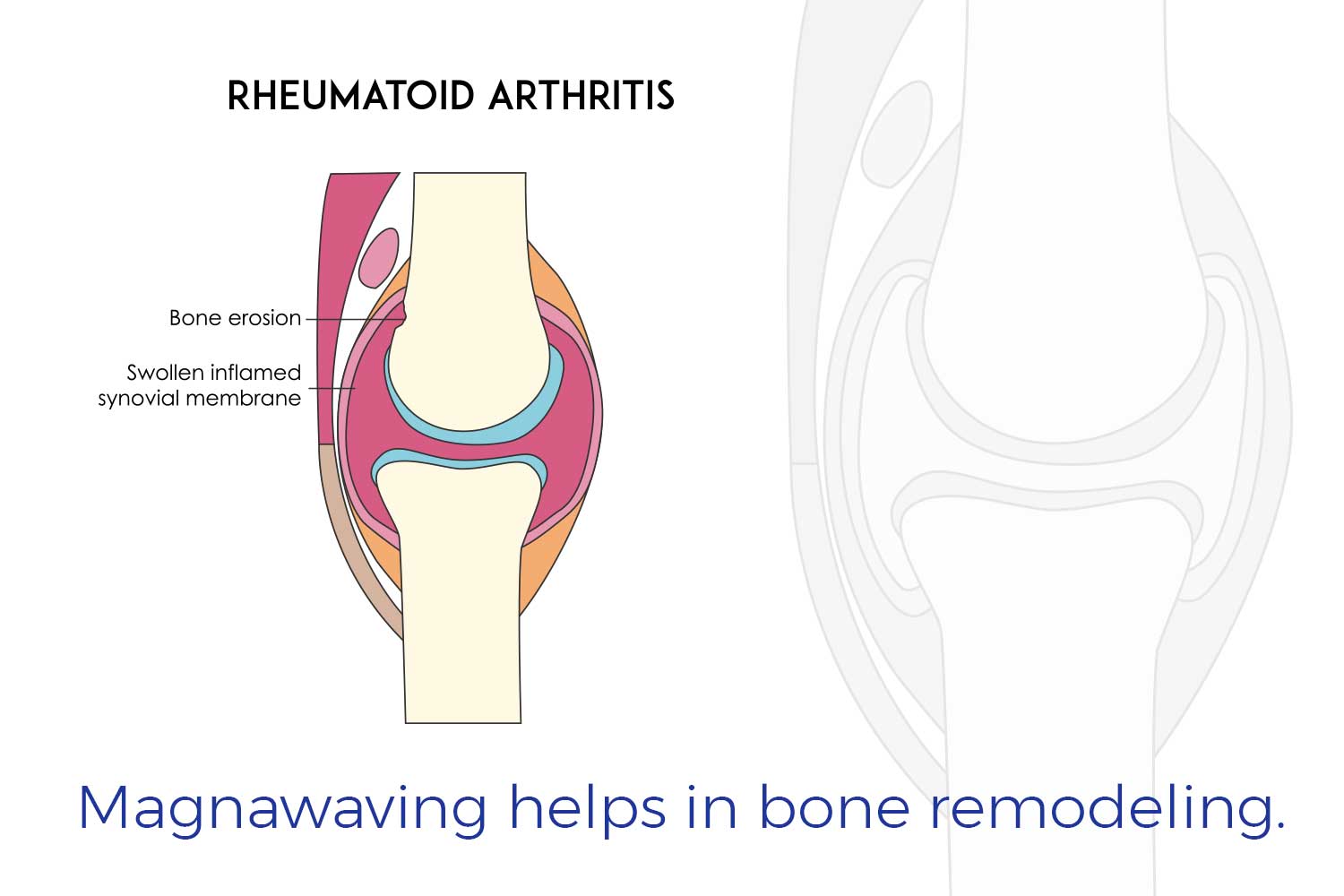 Magnawaving helps in bone remodeling.