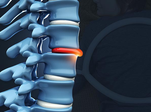 Herniated Disc Treatment