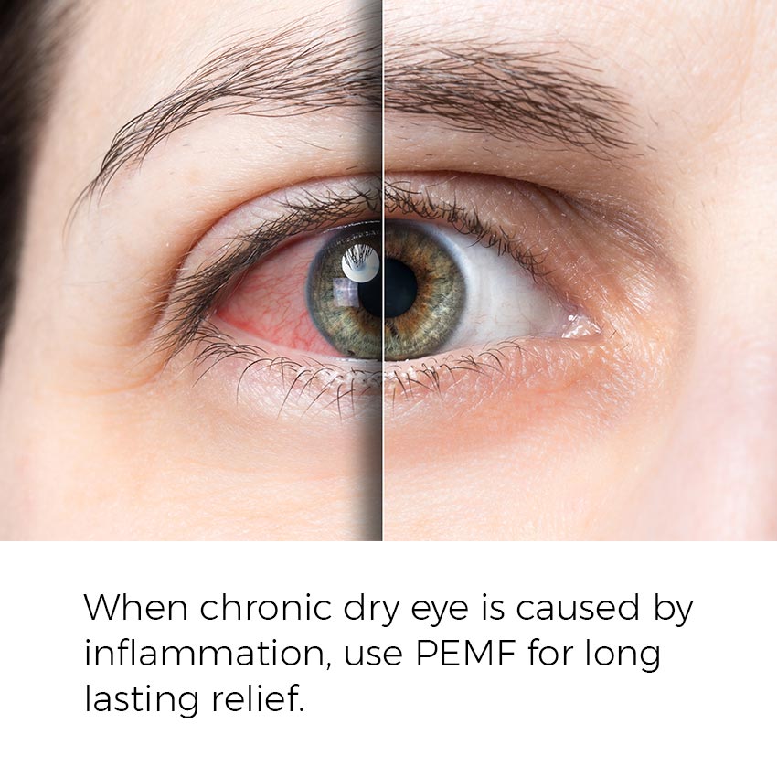 When chronic dry eye is caused by inflammation, use PEMF for long lasting relief.