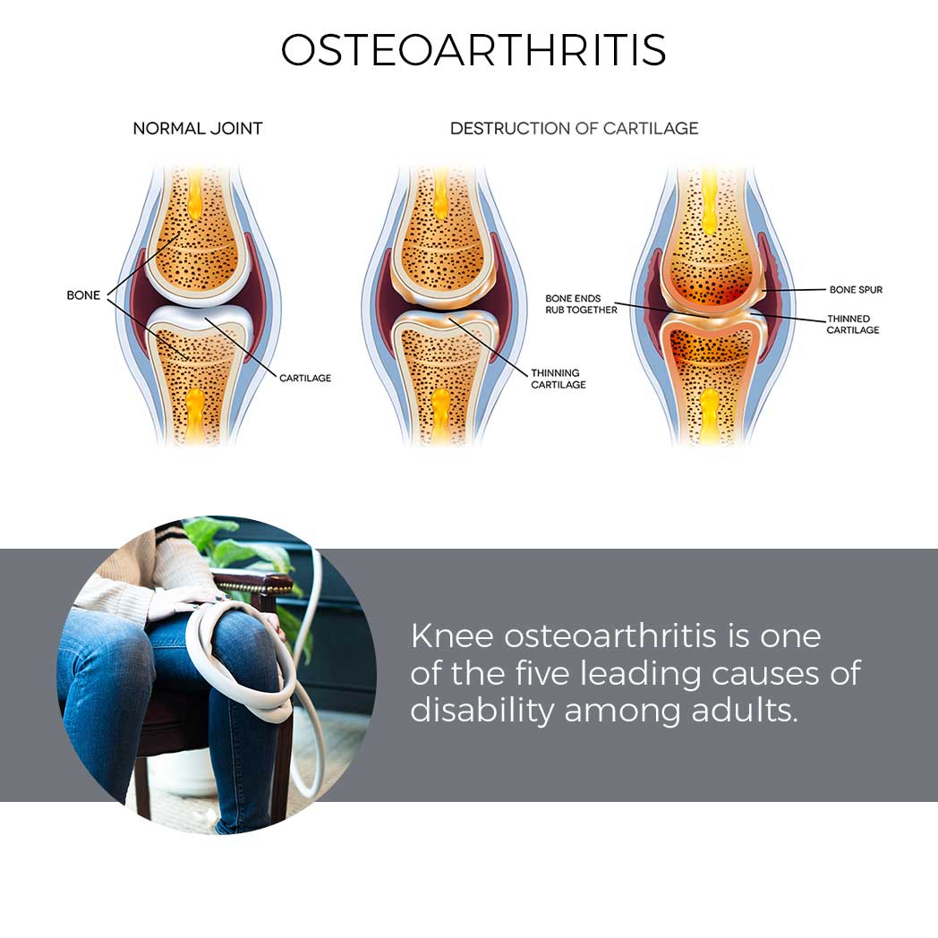 Magna Wave PEMF Best Treatment for Osteoarthritis - Diagram of Normal Knee Joint & Destruction of Cartilage - Knee osteoarthritis is one of the five leading causes of disability among non-institutionalized adults.
